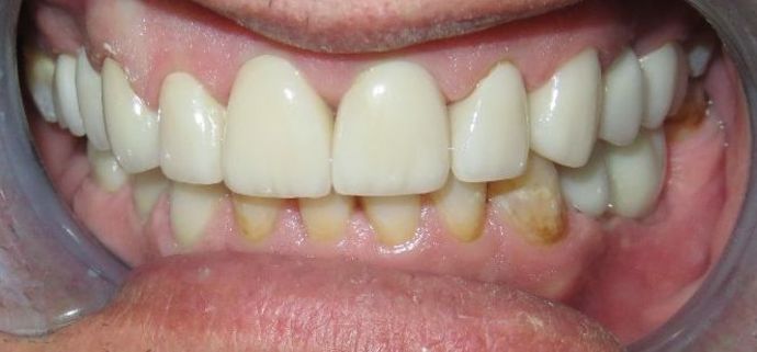 Dental Crowns Case 21 - After