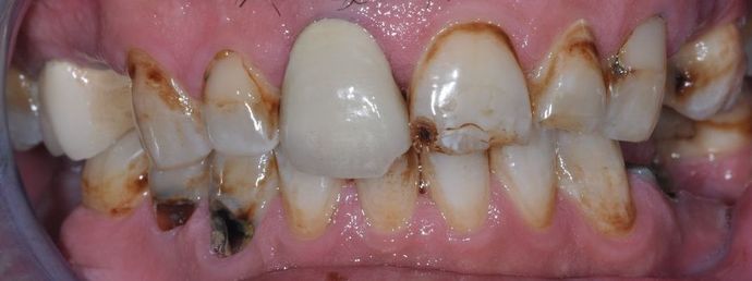 Dental Crowns Case 21 - Before