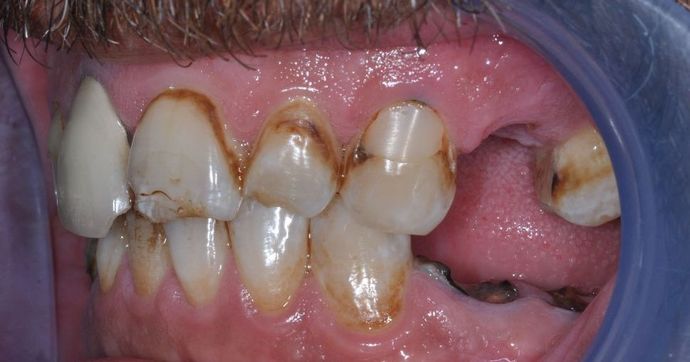 Dental Crowns: Case 21 - Before