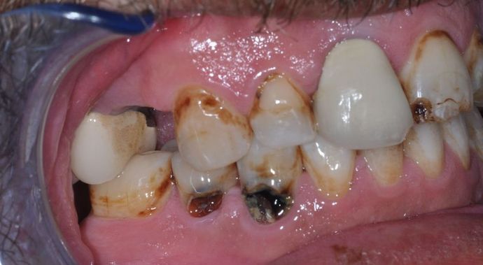 Dental Crowns: Case 21 - After