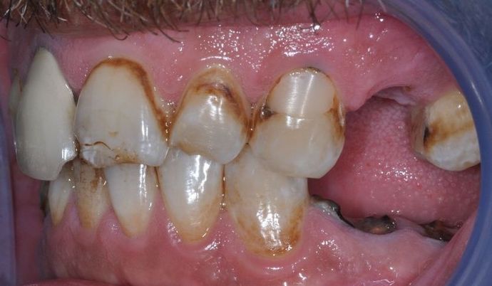 Dental Implants Case 2 - Before