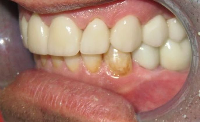 Dental Implants Case 2 - After