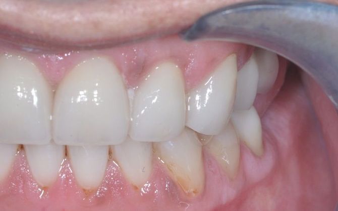Veneers: Case 12 - After