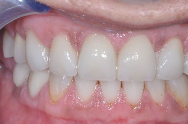 Veneers: Case 12 - After