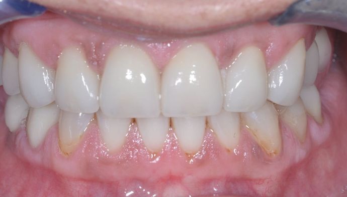 Veneers Case 12 - After