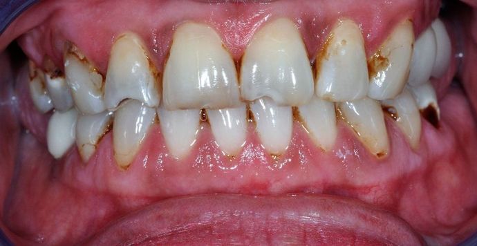 Veneers Case 12 - Before