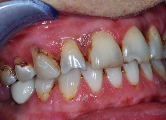 Veneers: Case 12 - Before