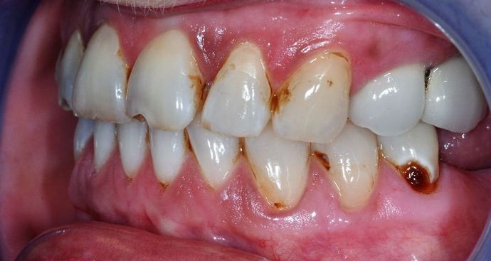 Veneers: Case 12 - Before