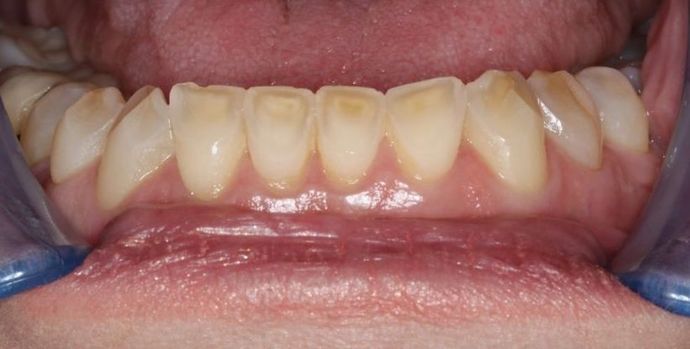 Veneers: Case 13 - Before