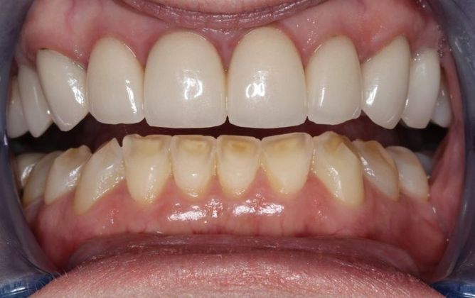 Veneers Case 13 - Before