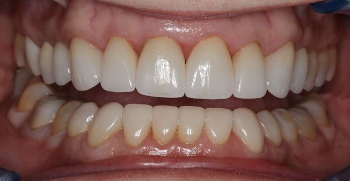 Veneers Case 13 - After
