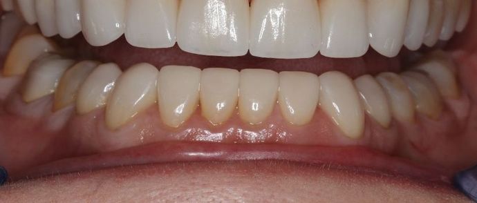 Veneers: Case 13 - After