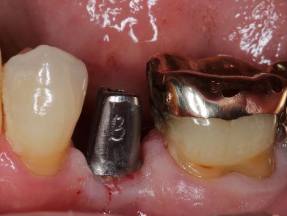 Dental Implants Case 4 - Before