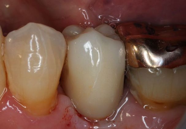 Dental Implants Case 4 - After