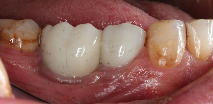 Dental Implants: Case 2 - After