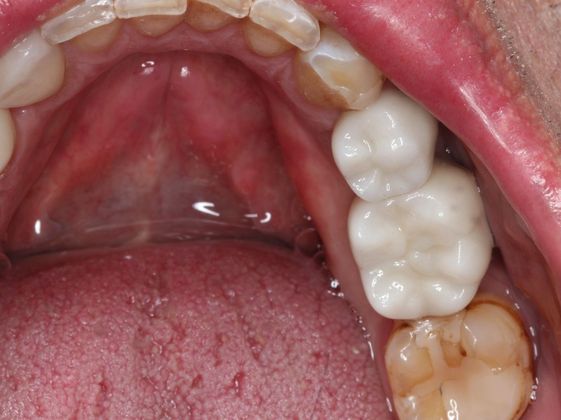 Dental Implants: Case 2 - Restoration