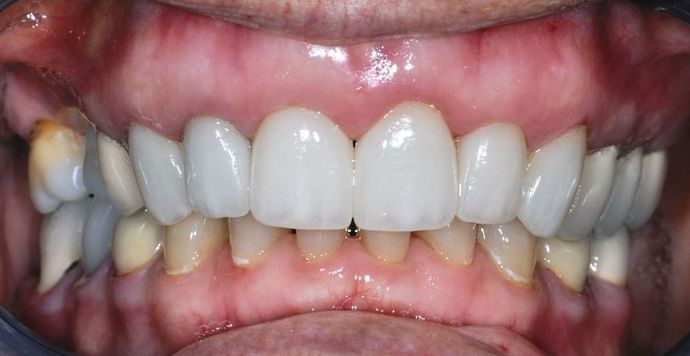 Dental Crowns Case 22 - After