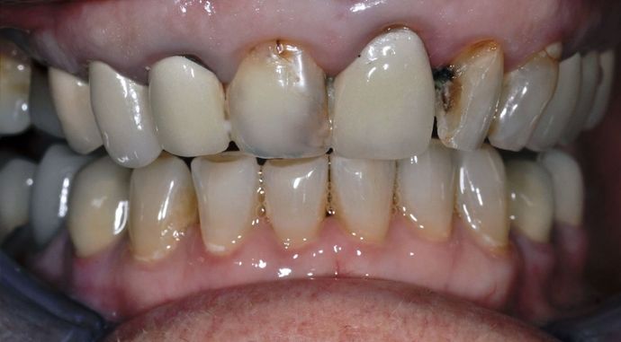 Dental Crowns Case 22 - Before