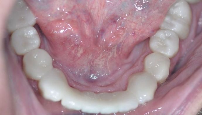Dental Implants: Case 3 - After