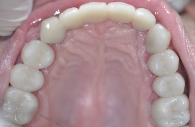 Dental Implants: Case 3 - After
