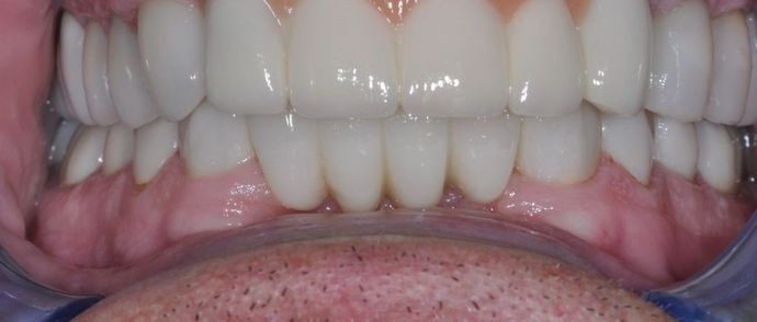Dental Implants: Case 3 - Before
