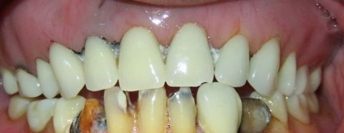 Teeth In A Day Case 19 - After