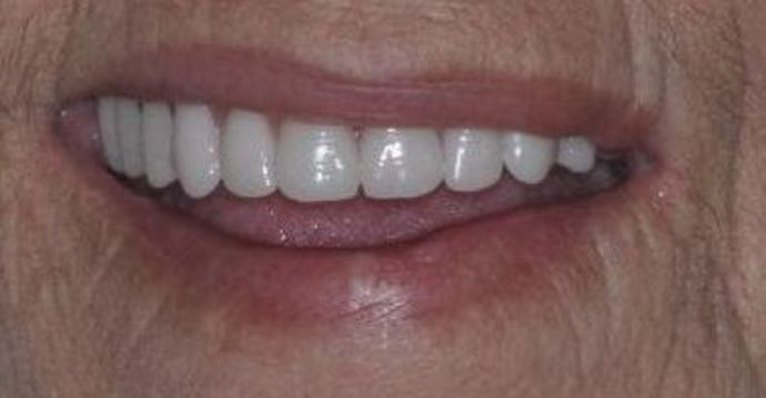 Teeth In A Day Case 19 - Before