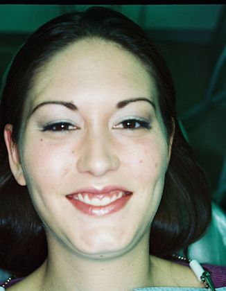 Gum Lift Case 6 - Before