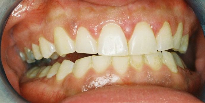Gum Lift: Case 6 - Before