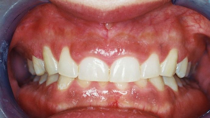 Gum Lift: Case 6 - Before