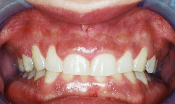 Gum Lift: Case 6 - After