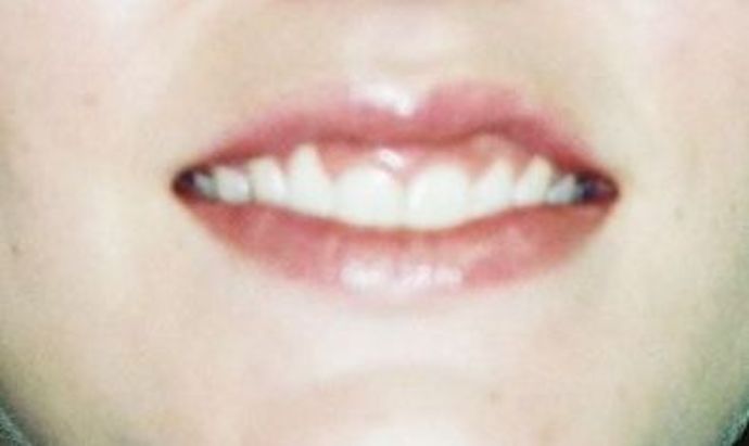 Gum Lift: Case 6 - Before