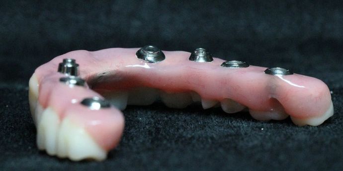 Teeth In A Day: Case 20 - No Palate 