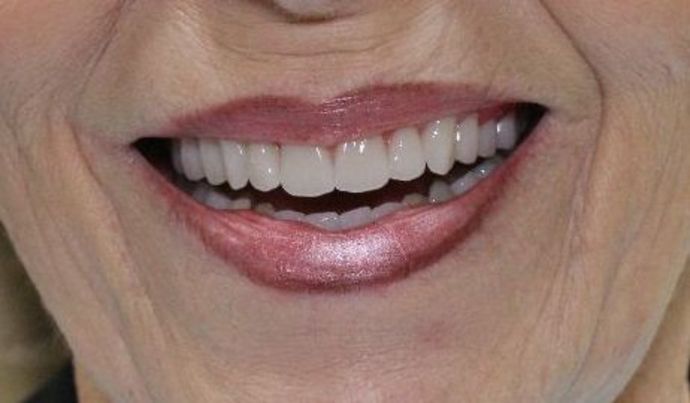 Dentures Case 2 - After