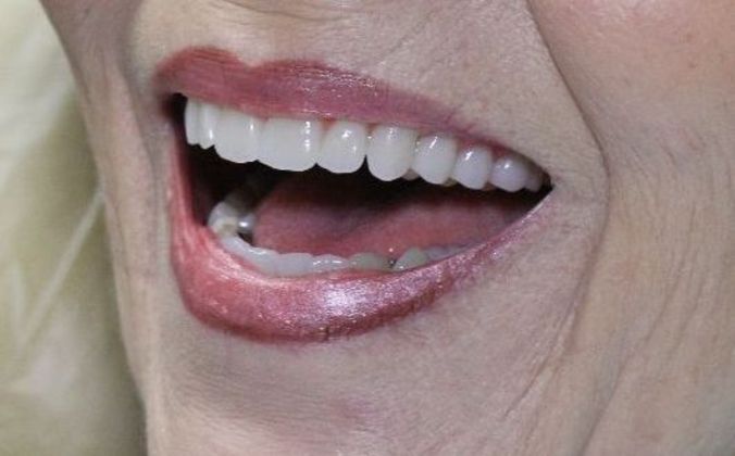 Dentures: Case 2 - After