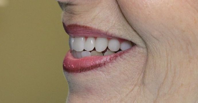 Dentures: Case 2 - After