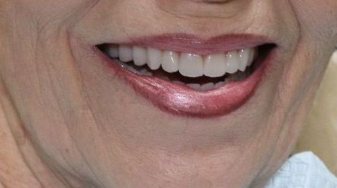 Dentures: Case 2 - After