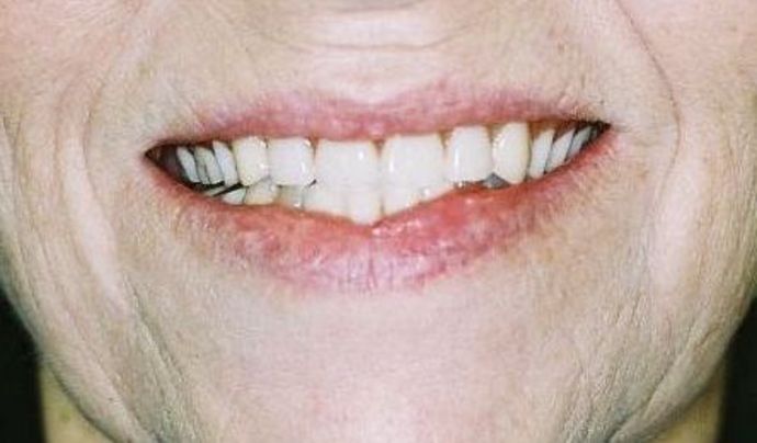 Dentures Case 2 - Before