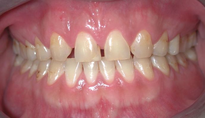 Veneers: Case 15 - Before