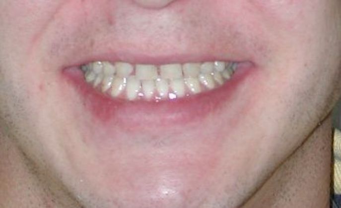 Veneers Case 15 - Before