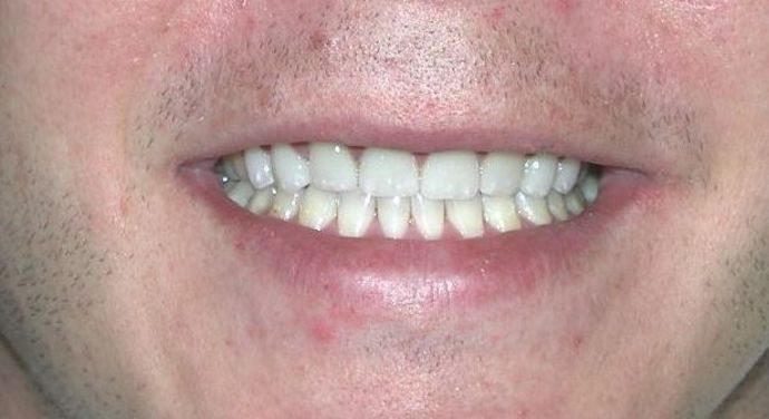 Veneers Case 15 - After