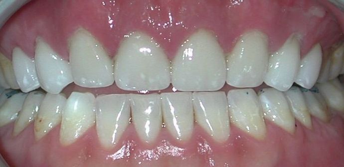 Veneers: Case 15 - After