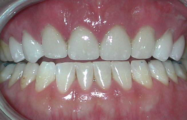 Veneers: Case 15 - After