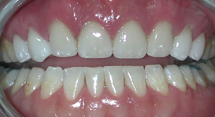 Veneers: Case 15 - After
