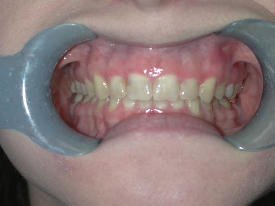 Gum Lift Case 2 - Before