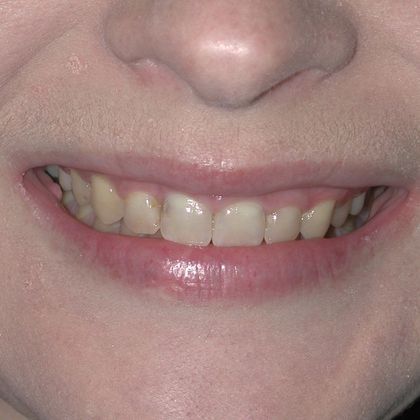 Gum Lift: Case 2 - After