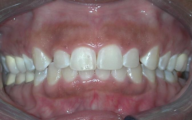 Gum Lift: Case 7 - Before
