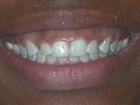 Gum Lift Case 7 - Before