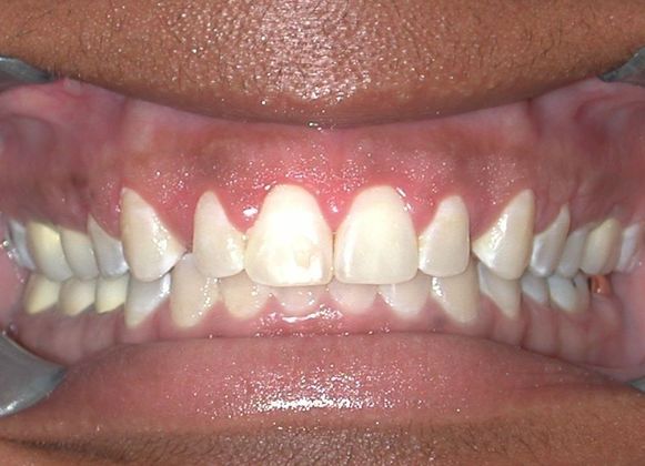 Gum Lift: Case 7 - After