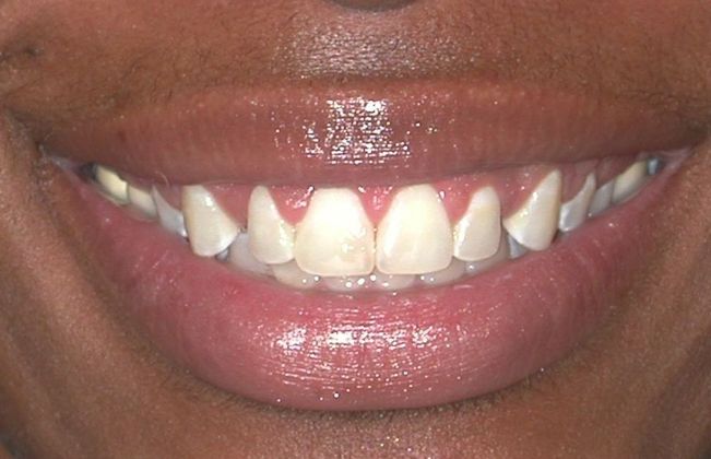 Gum Lift Case 7 - After